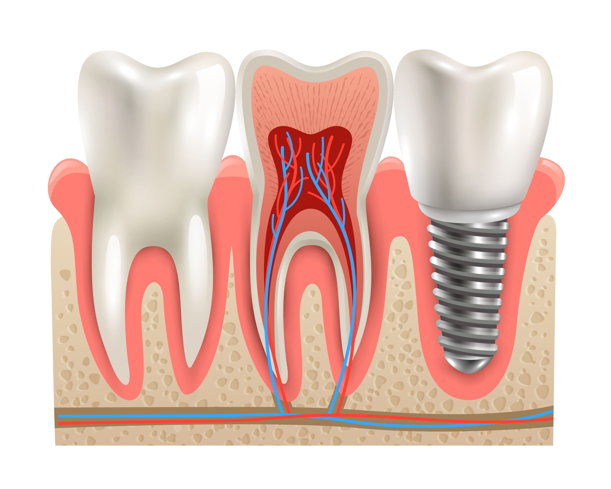 dental implants near me