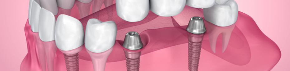 the many benefits of dental implants