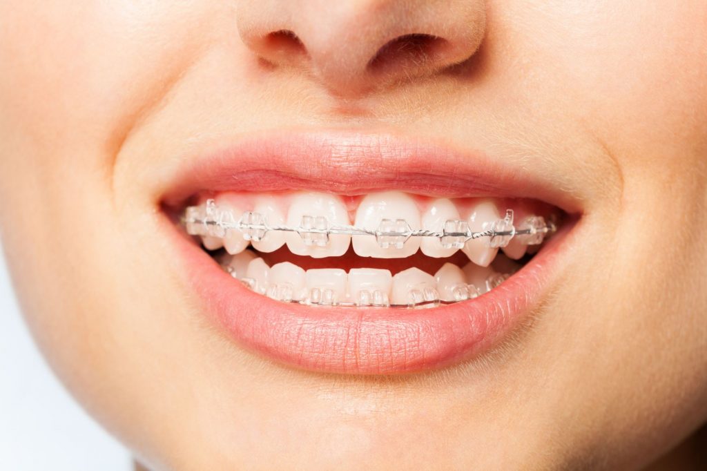 why use invisible braces
