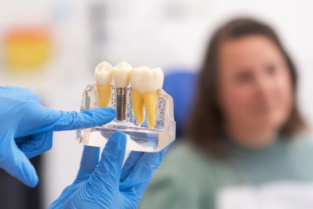 how to care fir single, bridge and full arch dental implants